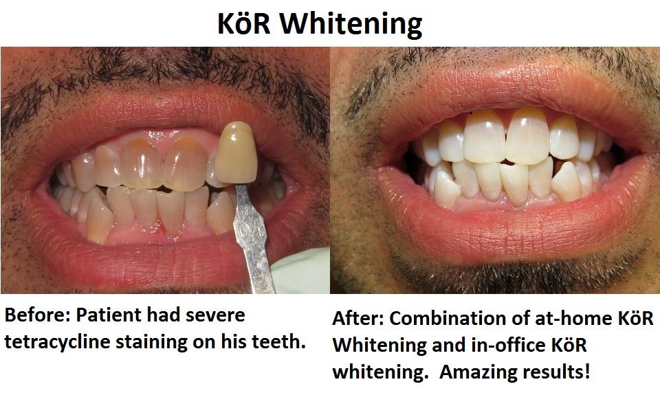 Simply Whiter Teeth with KöR Whitening | Caring Smiles ...