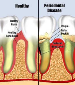 periodontal disease deep root cleaning planing scaling why need comments