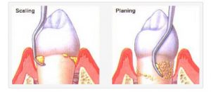 root-scaling-and-planing-nj