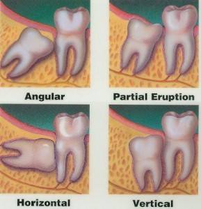 wisdom teeth coming in horizontally