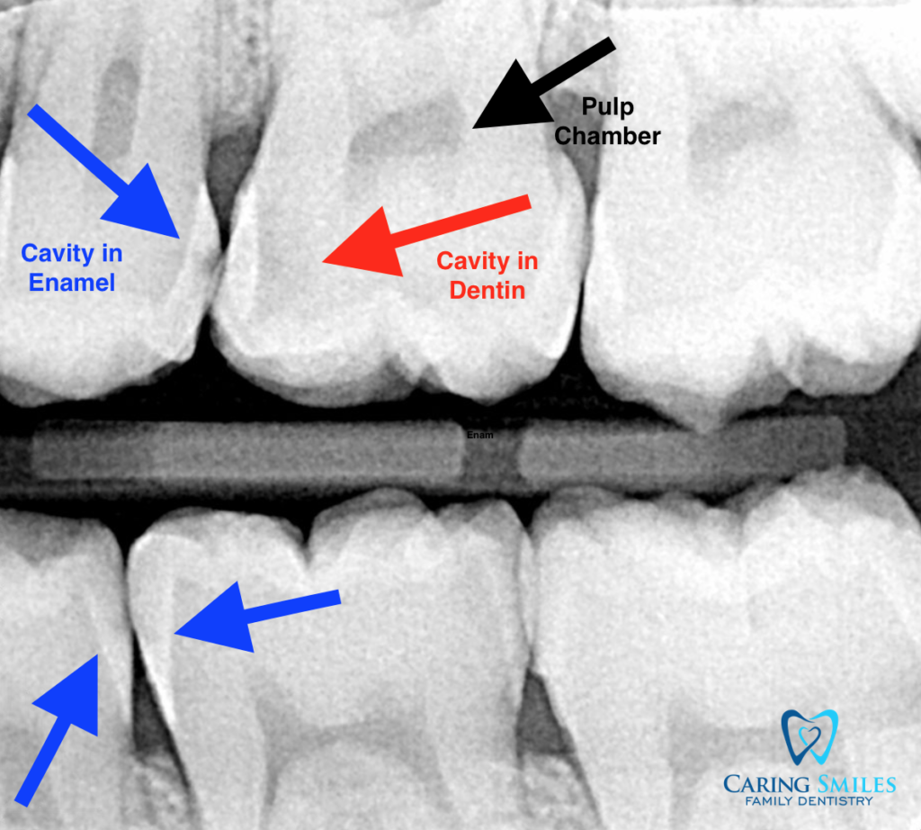 List 101+ Pictures Pictures Of Cavities In Teeth Completed