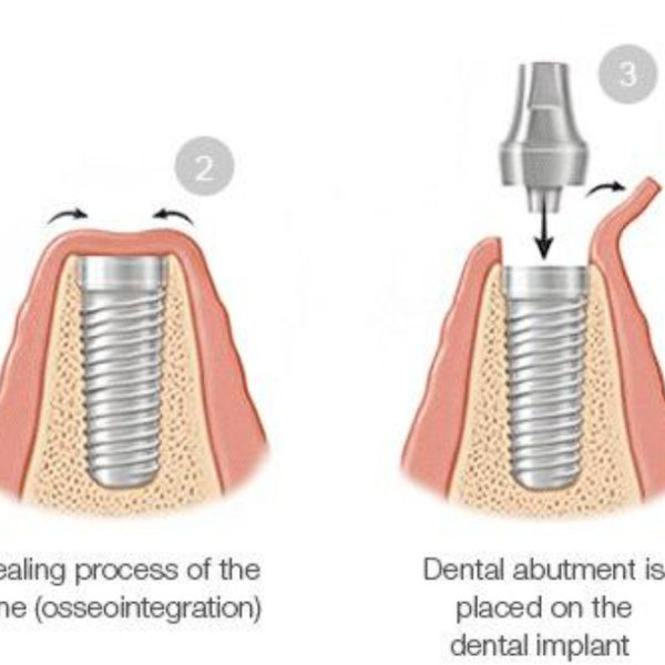 Replacing Missing Teeth With Dental Implants